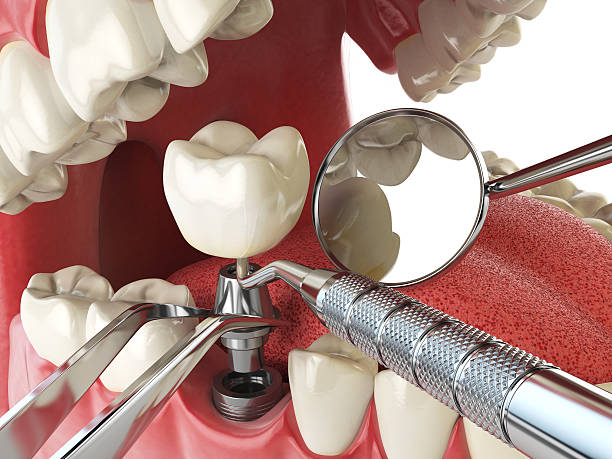 Best Emergency Root Canal Therapy in Orchard City, CO